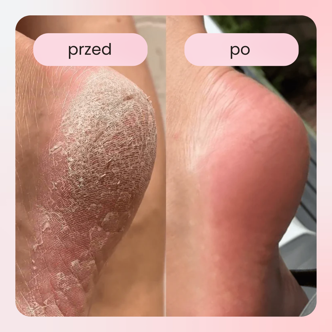 Elektryczne narzędzie do pielęgnacji stóp PediGlow – domowe SPA w Twojej dłoni!