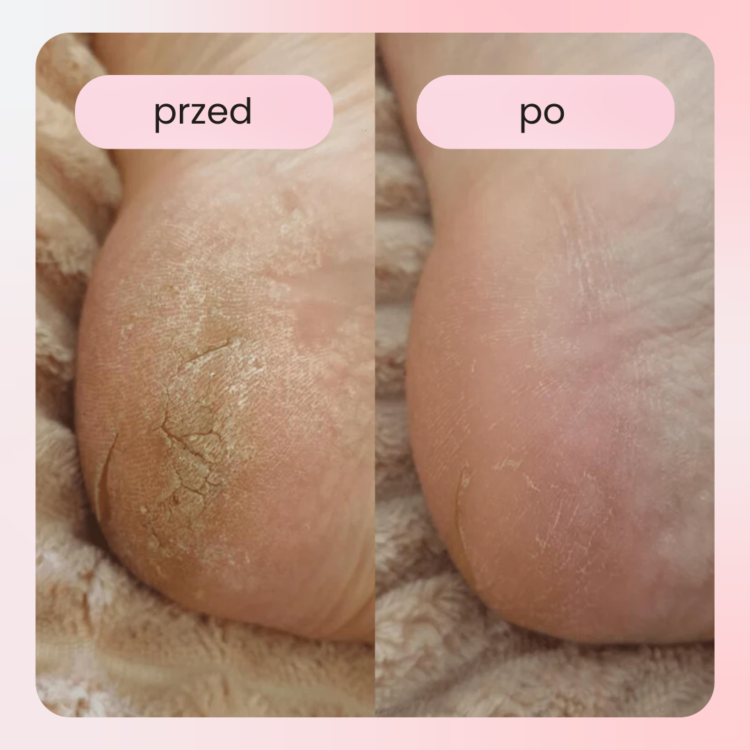 Elektryczne narzędzie do pielęgnacji stóp PediGlow – domowe SPA w Twojej dłoni!