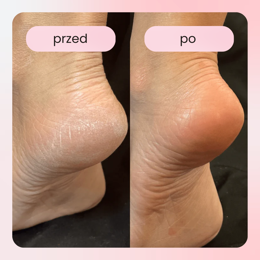 Elektryczne narzędzie do pielęgnacji stóp PediGlow – domowe SPA w Twojej dłoni!