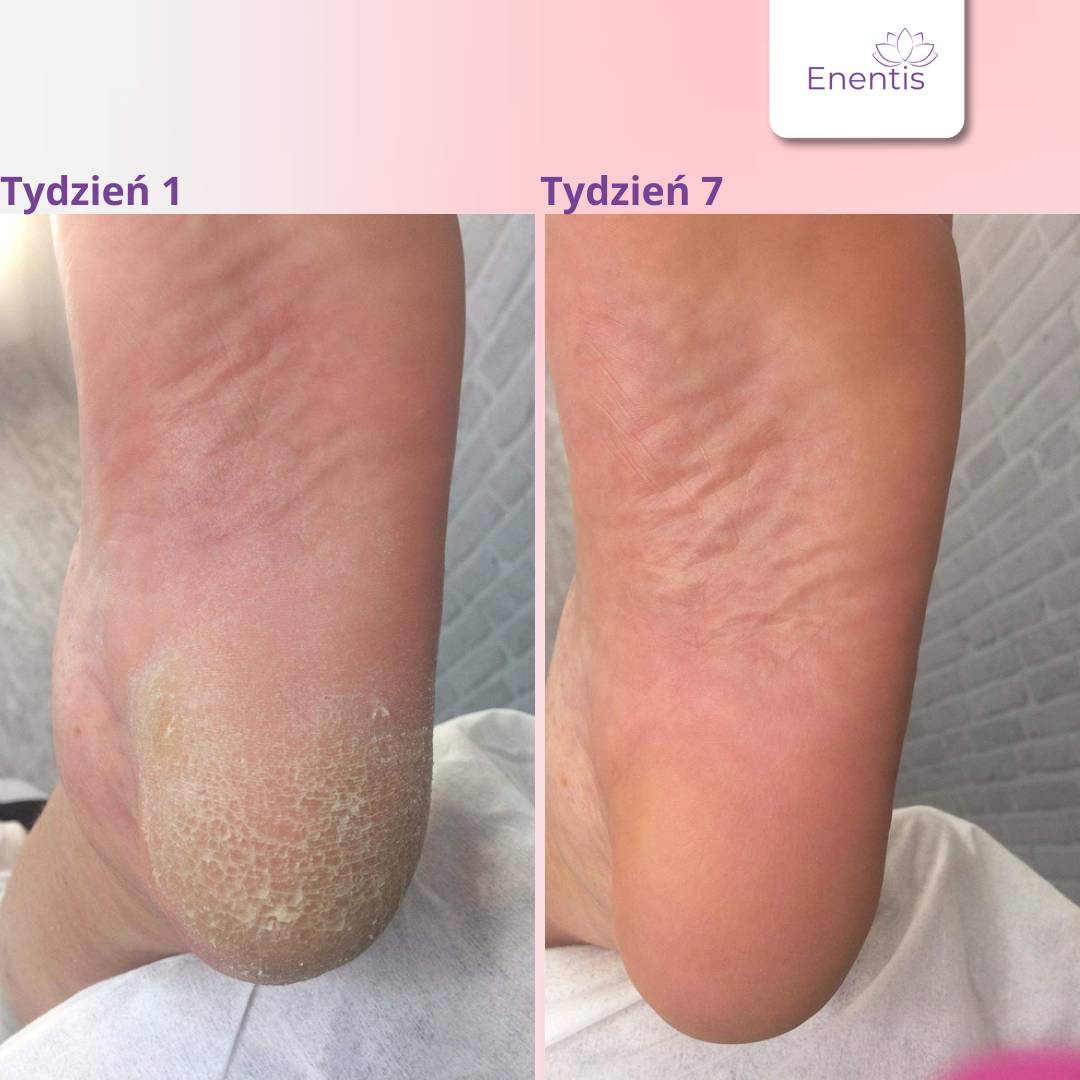 Skarpetki GlowFeet - zdrowe i nawilżone stopy od pierwszego użycia